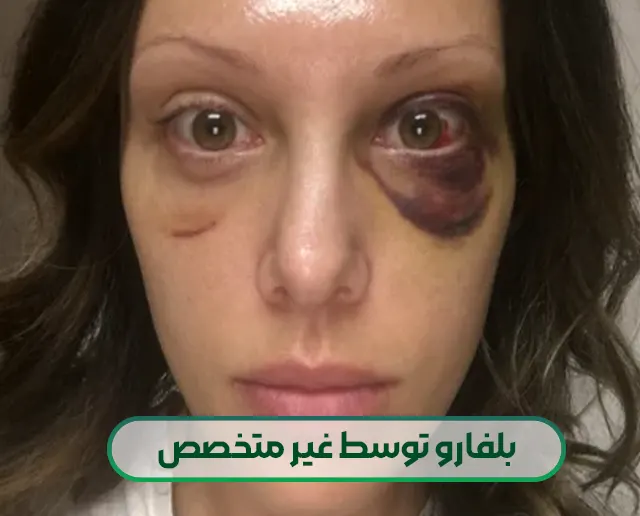 بلفارو توسط غیر متخصص