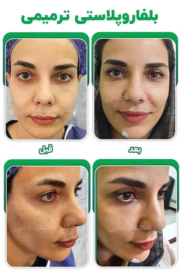 بلفاروپلاستی ترمیمی