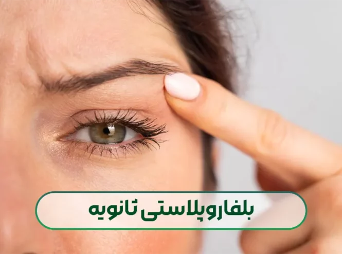 بلفاروپلاستی ثانویه