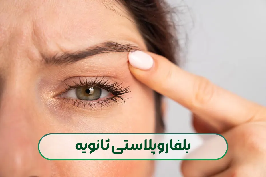 بلفاروپلاستی ثانویه