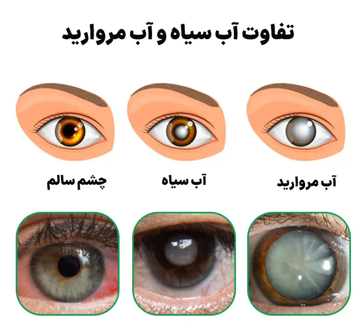 تفاوت آب سیاه و آب مروارید