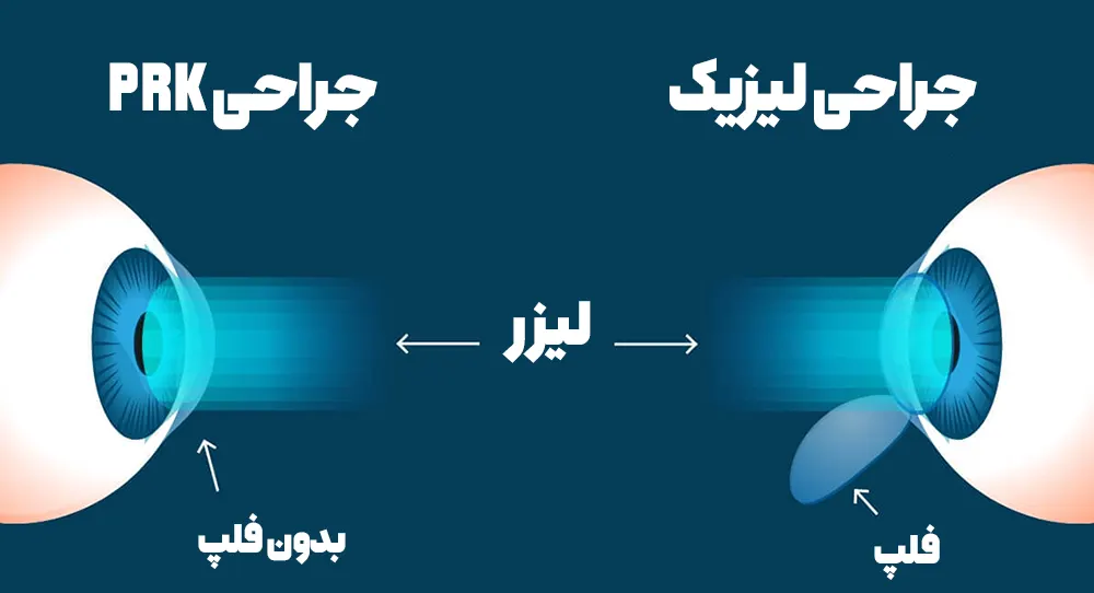 تفاوت جراحی لیزیک و PRK