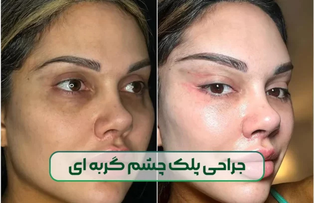 جراحی پلک چشم گربه ای