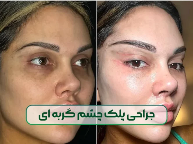 جراحی پلک چشم گربه ای