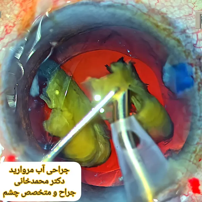 عمل آب مروارید توسط دکتر محمدخانی