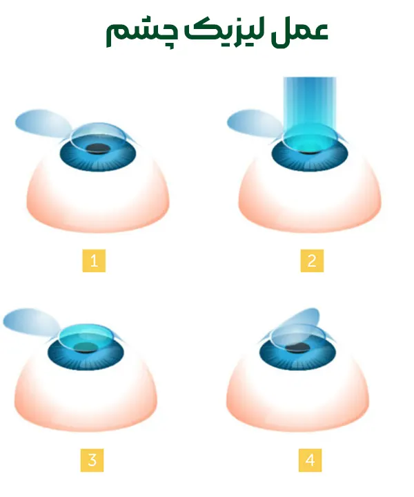 عمل لیزیک چشم
