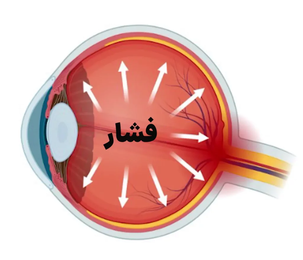 فشار چشمی ناشی از آب سیاه