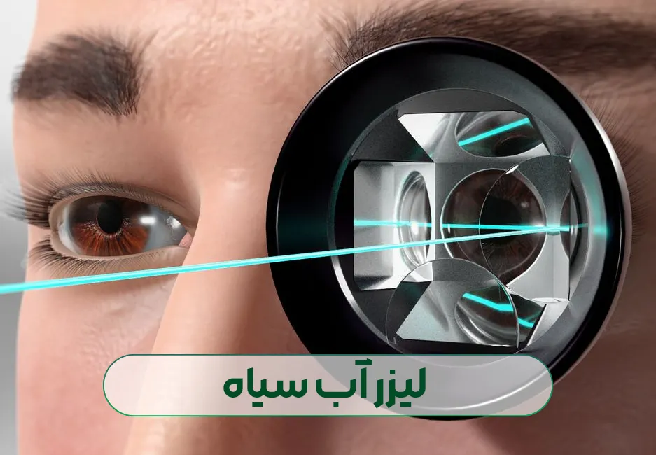 لیزر آب سیاه چشم