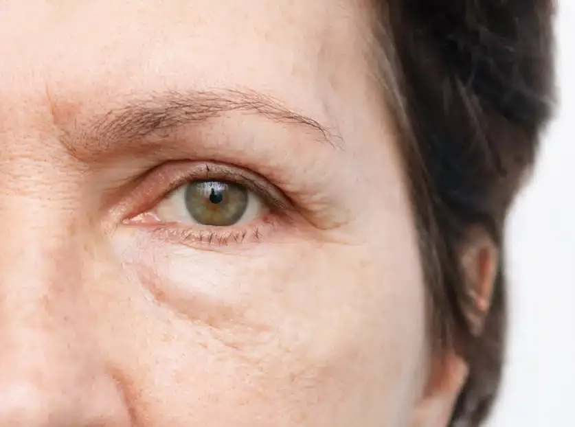 ماندگاری بلفاروپلاستی