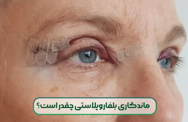 ماندگاری بلفاروپلاستی