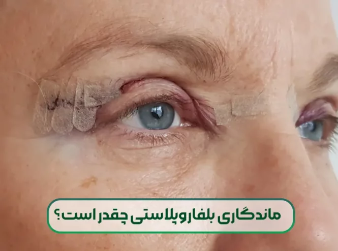 ماندگاری بلفاروپلاستی