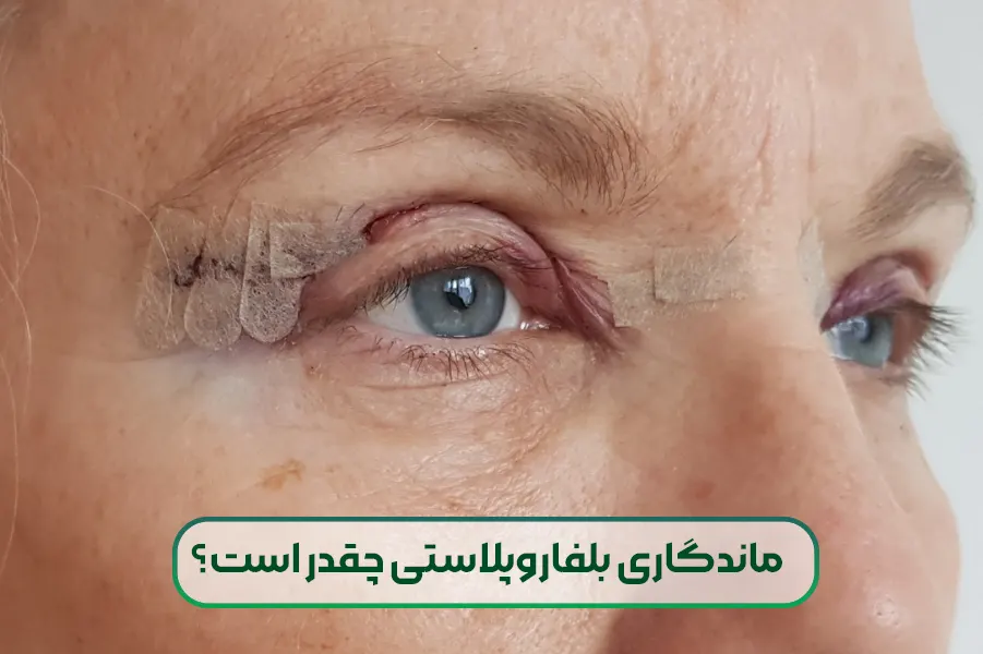 ماندگاری بلفاروپلاستی