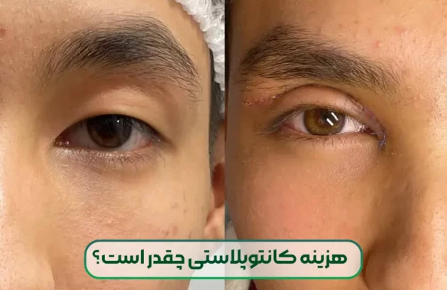 هزینه کانتوپلاستی