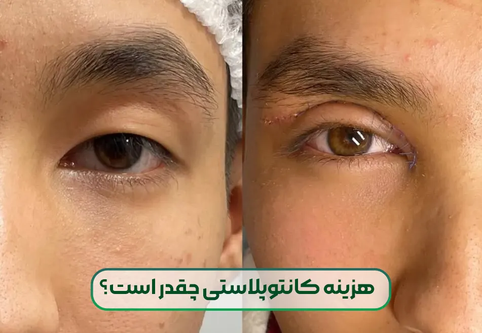 هزینه کانتوپلاستی