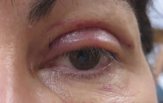 ورم بعد بلفاروپلاستی