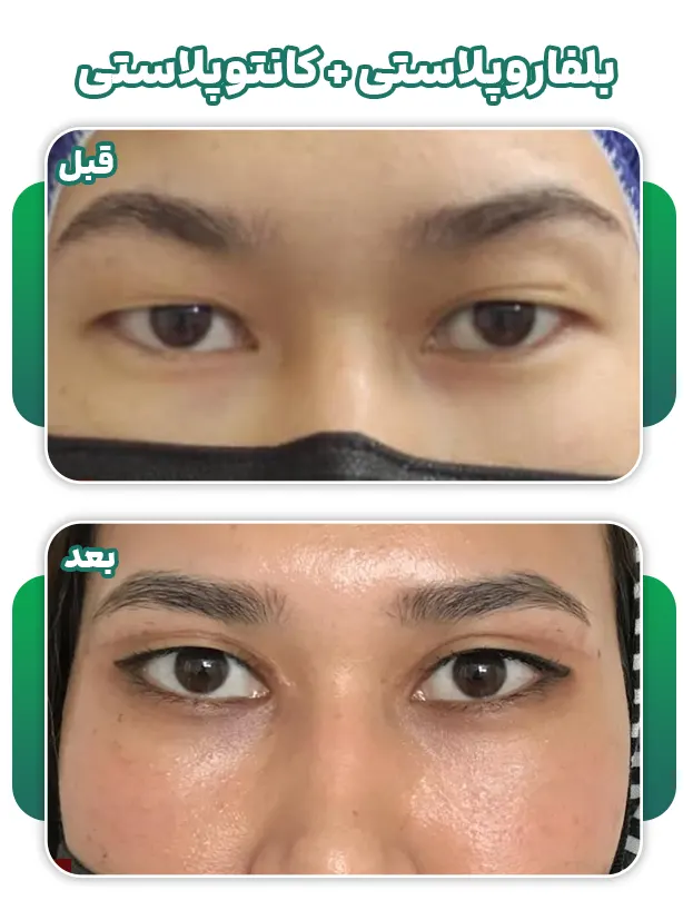 کانتورپلاستی