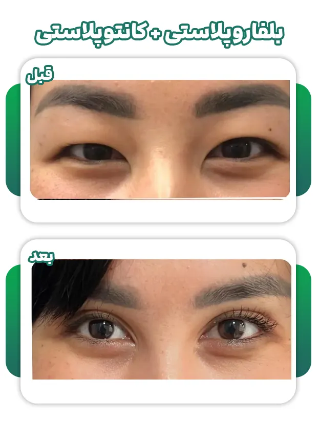 کانتورپلاستی