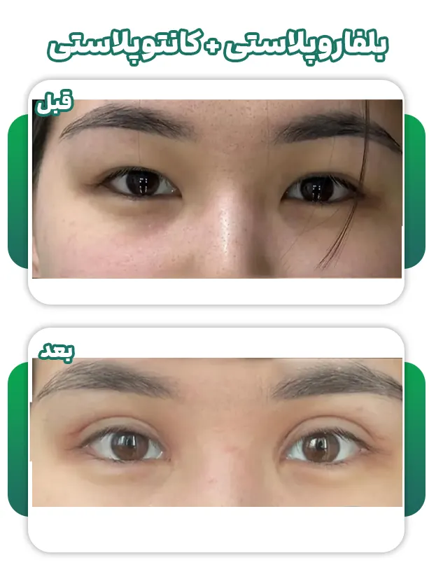 کانتورپلاستی