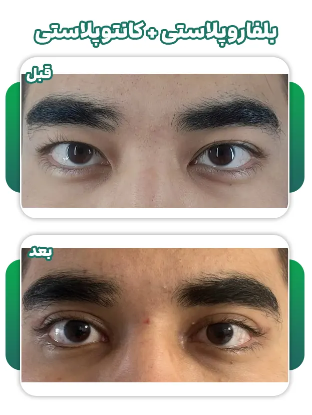 کانتورپلاستی