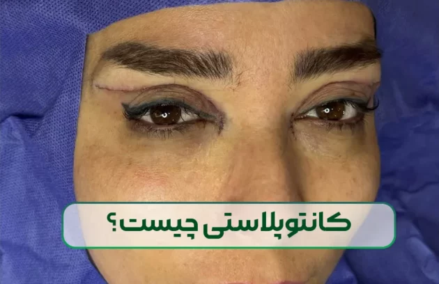 کانتوپلاستی چیست و هزینه آن چقدر است؟