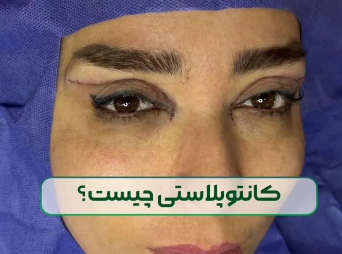 کانتوپلاستی چیست و هزینه آن چقدر است؟