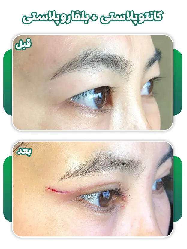 کانتوپلاستی+بلفاروپلاستی