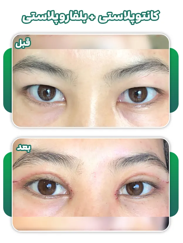 کانتوپلاستی+بلفاروپلاستی