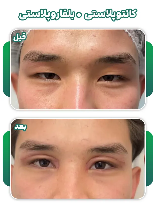 کانتوپلاستی+بلفاروپلاستی