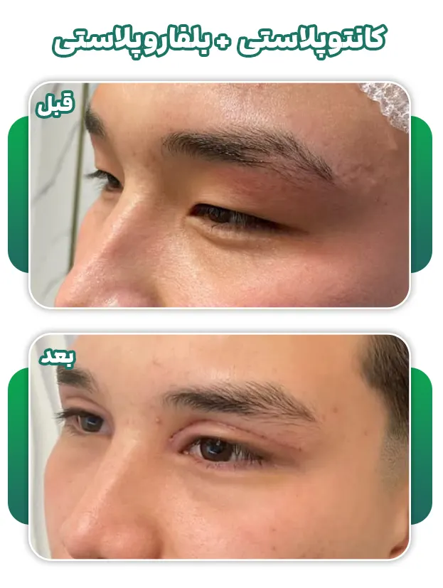 کانتوپلاستی+بلفاروپلاستی