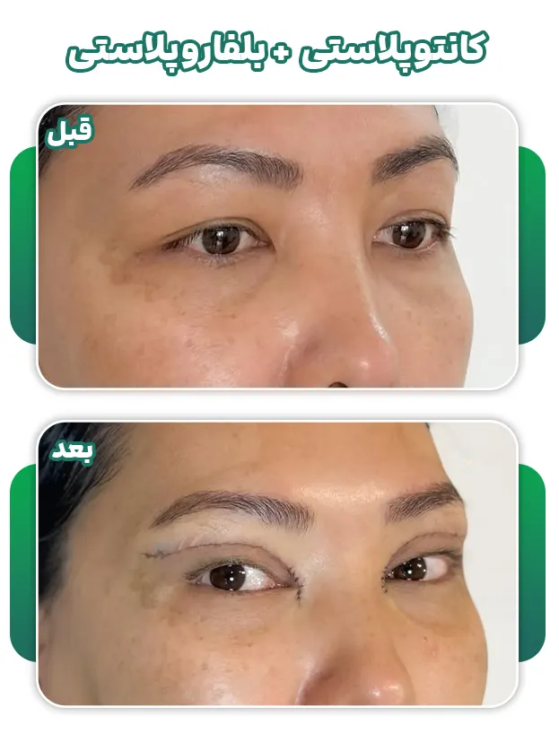 کانتوپلاستی