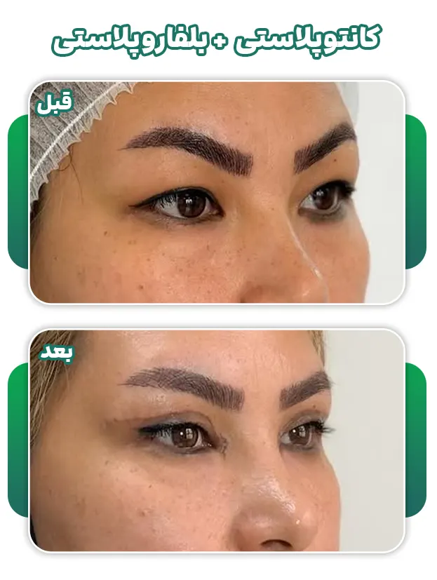 کانتوپلاستی+بلفاروپلاستی