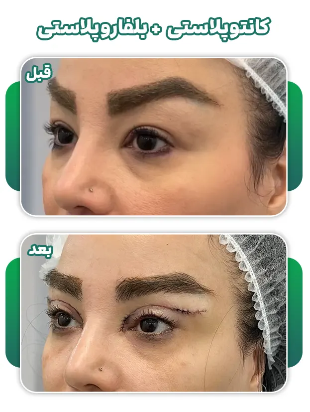 کانتوپلاستی+بلفاروپلاستی