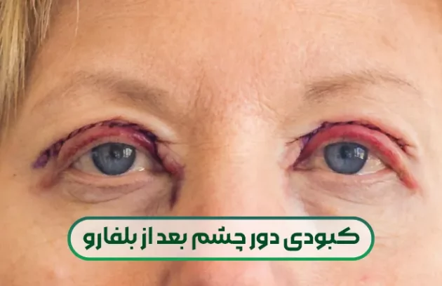 کبودی دور چشم بعد ازبلفارو