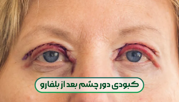 کبودی دور چشم بعد ازبلفارو