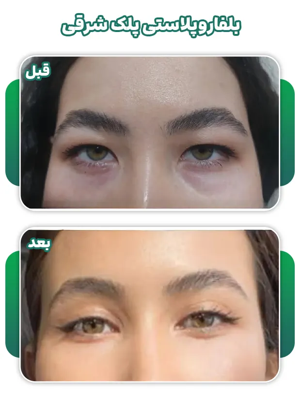 بلفاروپلاستی پلک شرقی