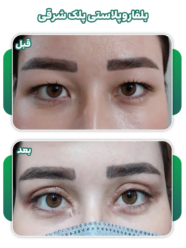 بلفاروپلاستی پلک شرقی