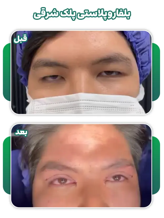 بلفاروپلاستی پلک شرقی