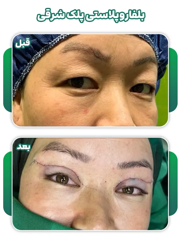 بلفاروپلاستی پلک شرقی