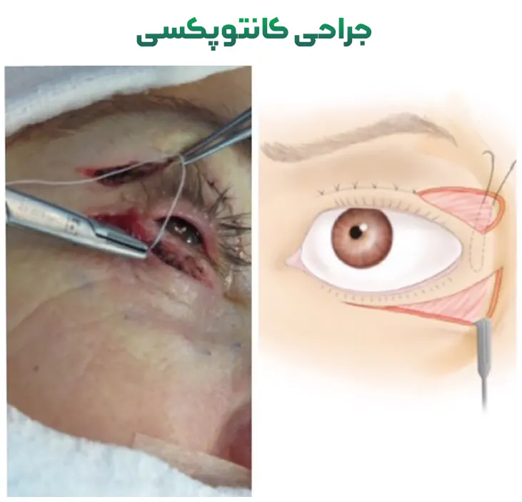 کانتوپکسی چیست؟