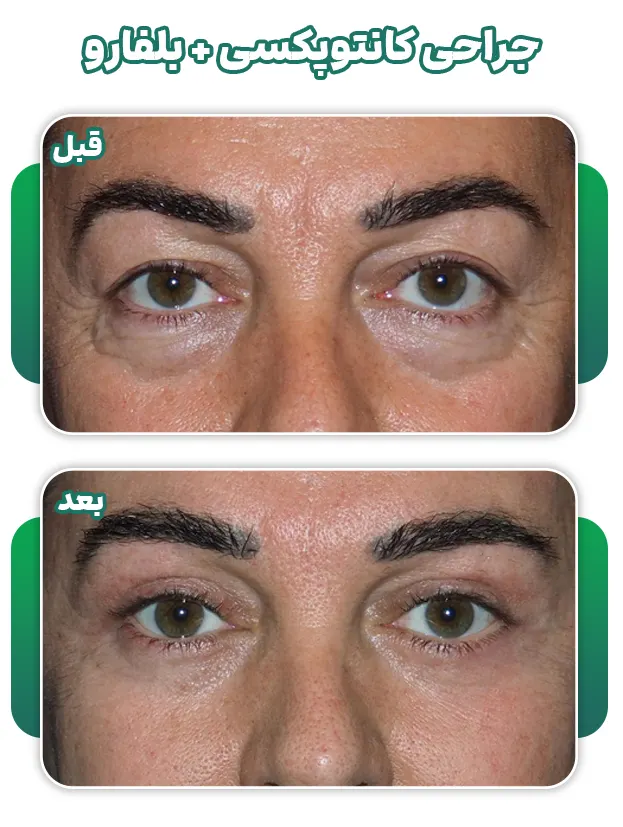 قبل و بعد کانتوپکسی