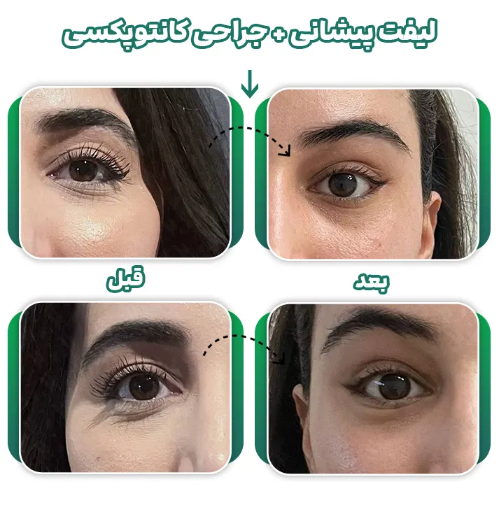 قبل و بعد جراحی کانتوپکسی