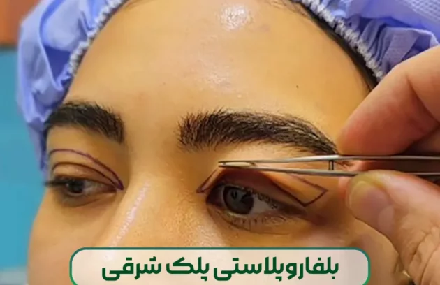 بلفاروپلاستی پلک شرقی