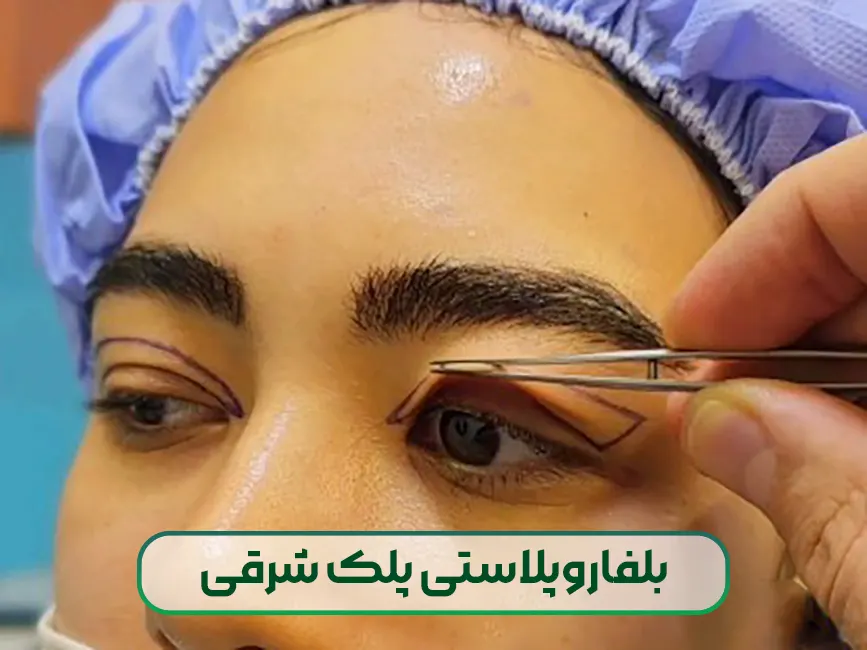 بلفاروپلاستی پلک شرقی
