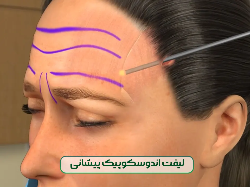 لیفت اندوسکوپیک پیشانی