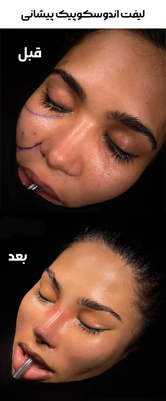 لیفت اندوسکوپیک پیشانی