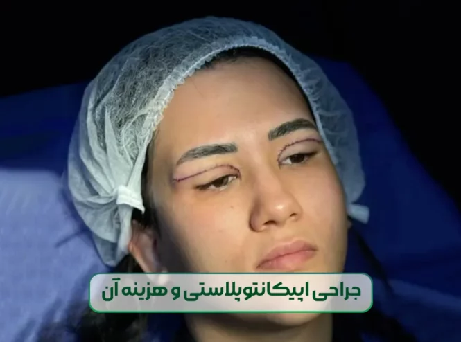 اپیکانتوپلاستی