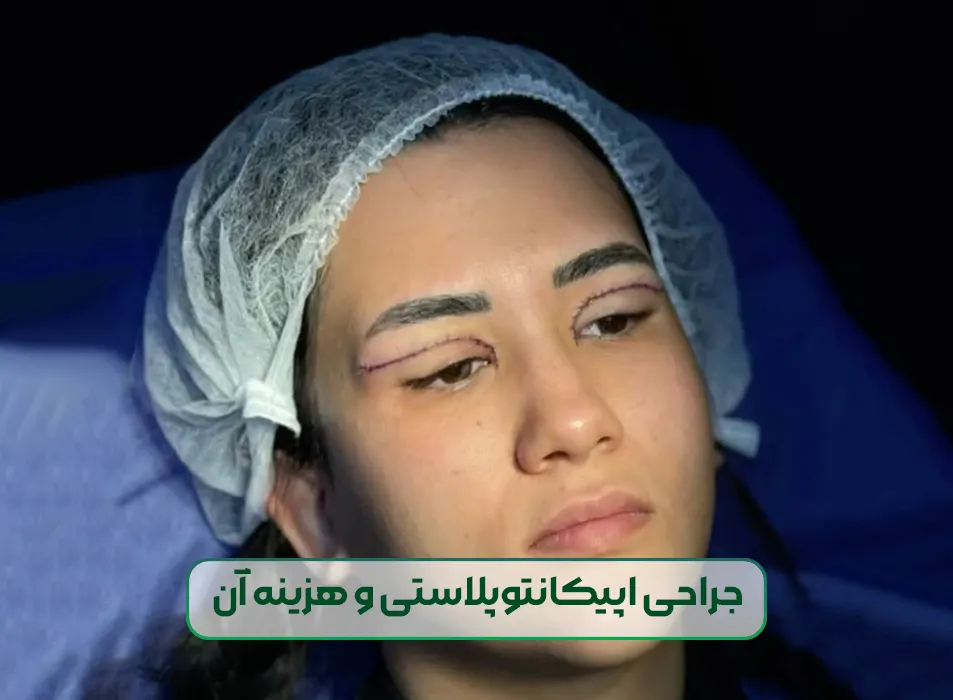 اپیکانتوپلاستی