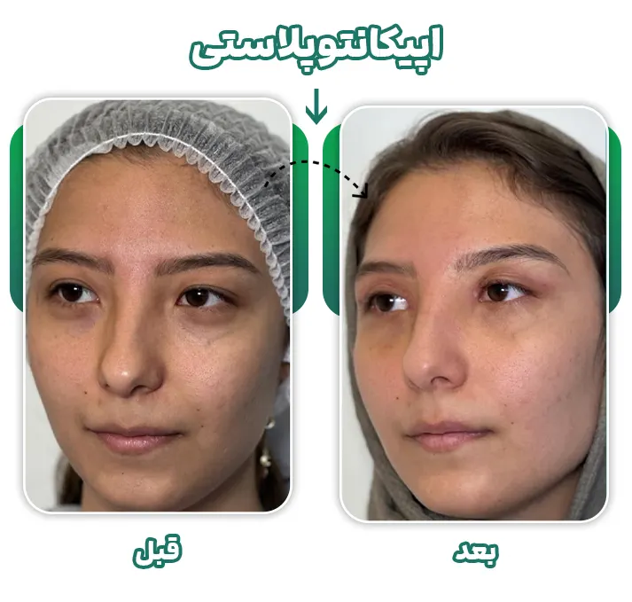 اپیکانتوپلاستی