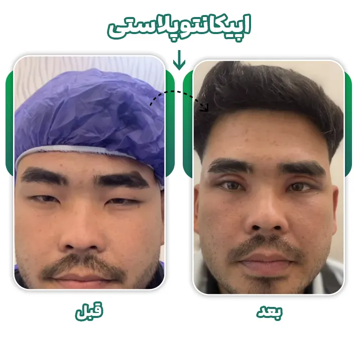 اپیکانتوپلاستی