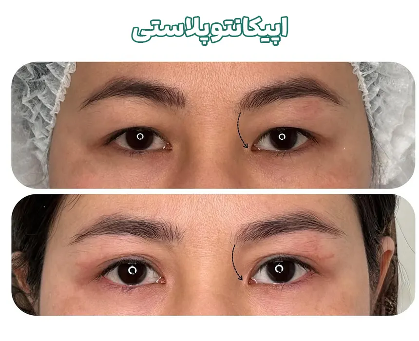 اپیکانتوپلاستی